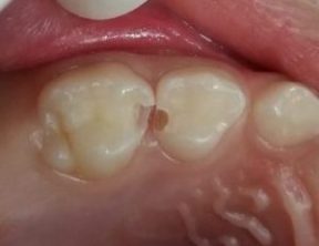 子供の歯の虫歯治療  市川市の歯医者｜行徳スマイル歯科