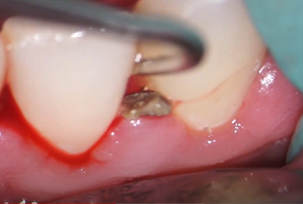 歯石 除去 血 の 塊