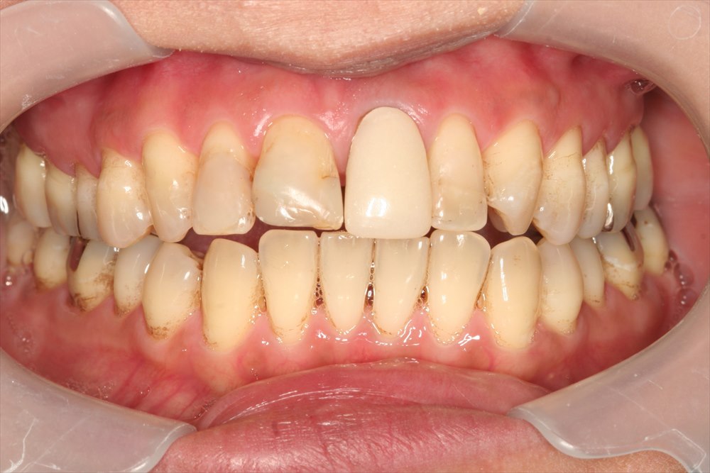 前歯のセラミック修復