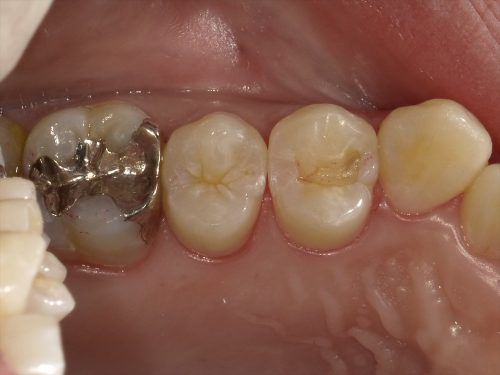 健康な歯を残したい人の為の虫歯治療について 市川市の歯医者 行徳スマイル歯科