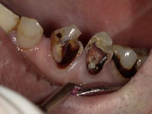 非常に大きな虫歯の治療