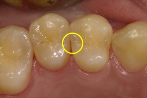 虫歯の早期発見・早期治療