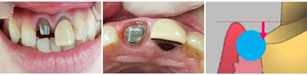 仮歯の除去・土台形成