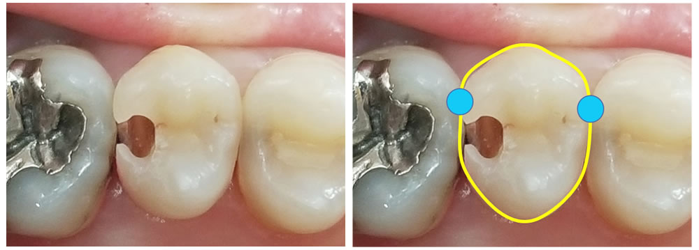虫歯感染歯質の切削