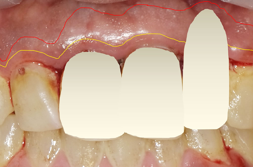 歯肉の状態を確認