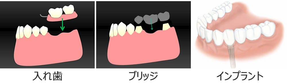前歯の咬み合わせ回復治療