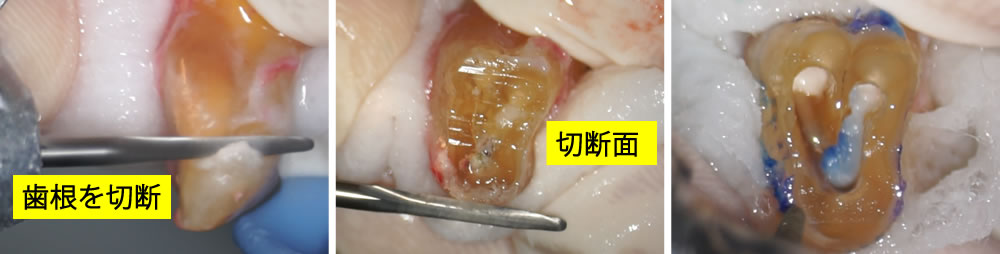 歯根先端部分の切除