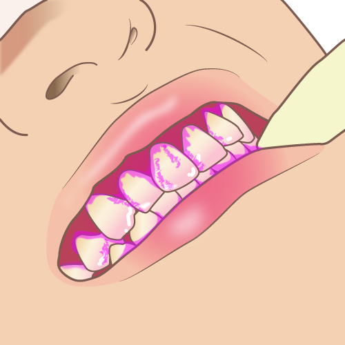 歯のPCR検査